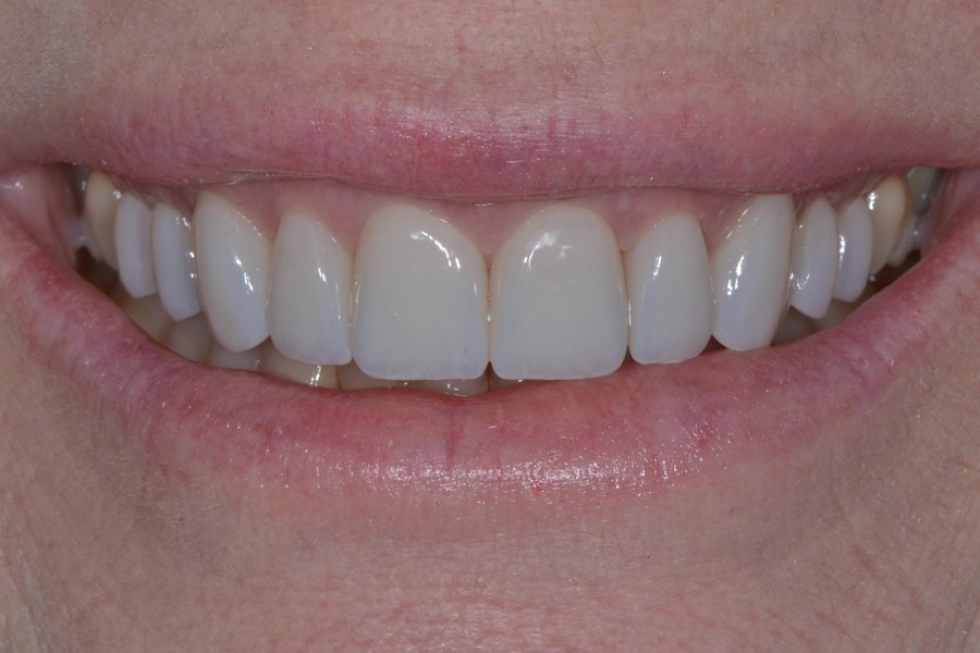 Stacy's smile after treatment