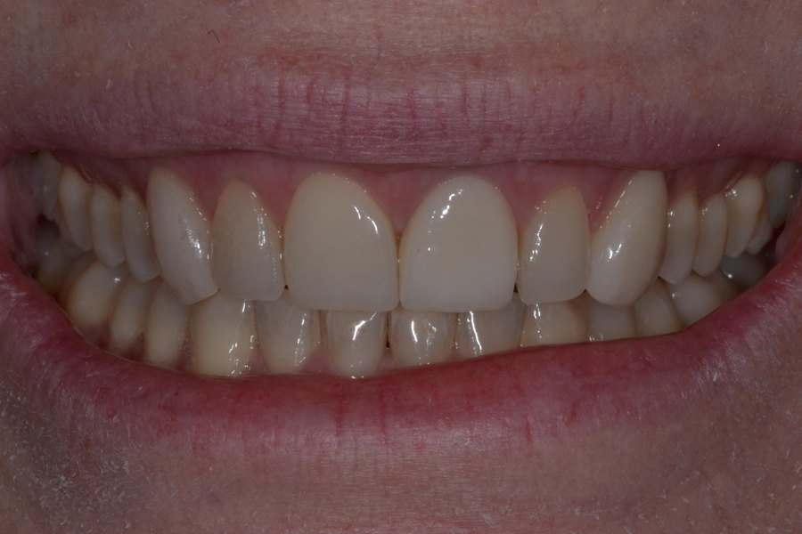 Stacy's smile before treatment