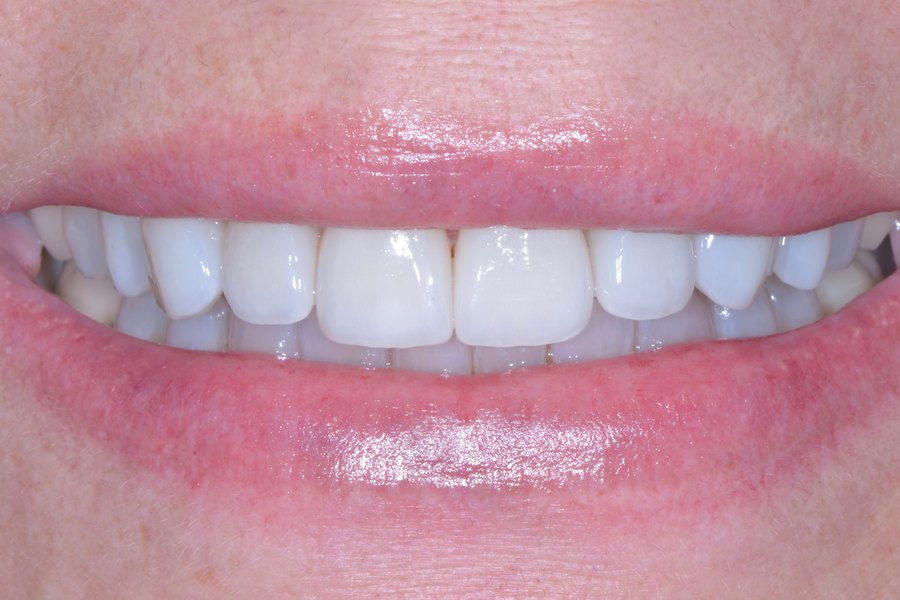 Terry's smile after treatment