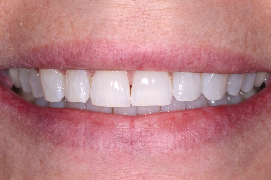 Terry's smile before treatment