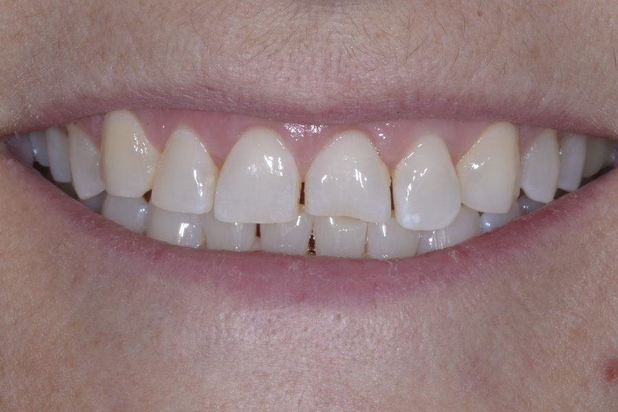 Tina's smile before treatment